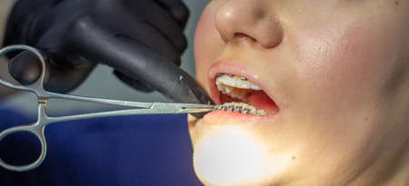 A woman with braces visits an orthodontist, in a dental chair. during the procedure of installing the arch of braces on the lower teeth. The dentist is wearing gloves and holding a pair of forceps.の写真素材