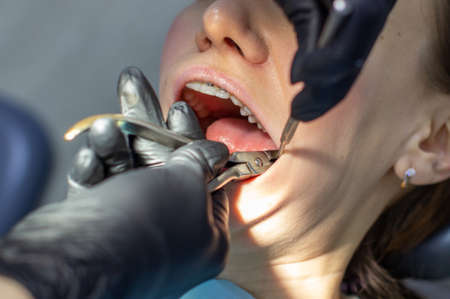 A woman with dental braces visits an orthodontist at the clinic. in the dental chair during the procedure of installing braces on the upper and lower teeth. Dentist and assistant work together, they have dental instruments in their hands. concept of dentistryの写真素材
