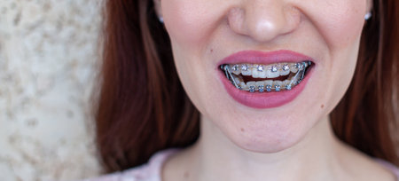 Braces on the teeth of a girl who smiles, close-up lips,の写真素材
