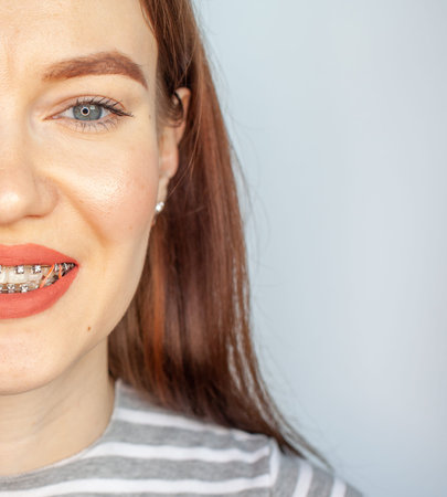 Braces in the smiling mouth of a girl. Close-up photos of teeth and lips. Smooth teeth from braces....