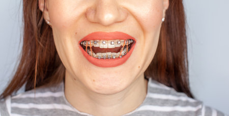 Braces in the smiling mouth of a girl. Close-up photos of teeth and lips. Smooth teeth from braces. On the teeth of elastic bands for tightening teeth. Photo on a light solid background.の写真素材