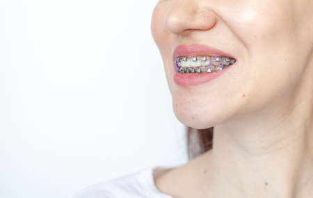 Braces in the smiling mouth of a girl. Smooth teeth from braces.の写真素材