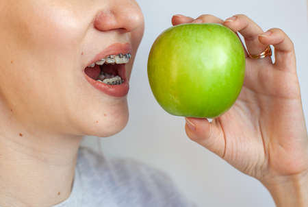 A girl with braces on her teeth wants to bite a green apple. Close-up photos of teeth and lips. Smooth teeth from braces. Photo on a light solid background.の写真素材