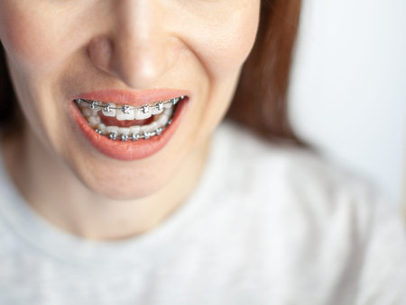 The smile of a young girl with braces on her white teeth. Teeth straightening.