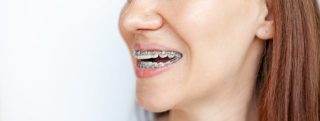 The woman smiles, showing her white teeth with braces. Even teeth from wearing braces. The concept...