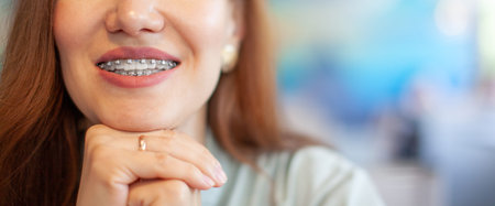 The smile of a young girl with braces on her white teeth.