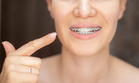 The girl points her finger at the even and white teeth with braces. Straightening your teeth with...