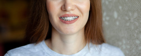 The smile of a young and beautiful girl with braces on her white teeth. Straightening of crooked teeth with the help of a bracket system. Malocclusion. Dental care. Smooth teeth and a beautiful smileの写真素材