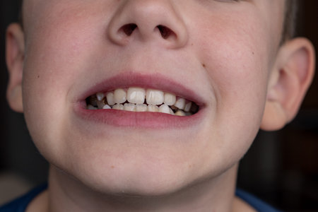 Childs crooked teeth. Young man showing crooked growing teeth.
