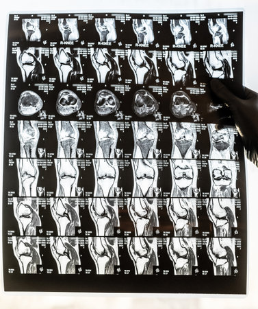 Magnetic resonance imaging of human knee joint for medical diagnosisの写真素材
