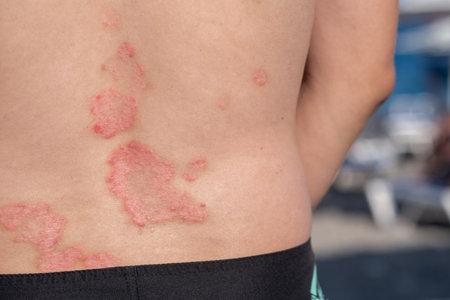 A person stands with visible psoriasis patches on their back, enjoying a beach atmosphere while surrounded by sun and relaxation.の写真素材