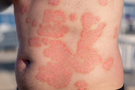 Red patches of psoriasis are prominently displayed on the torso of an individual outdoors, highlighting the skin condition in a natural setting.の写真素材
