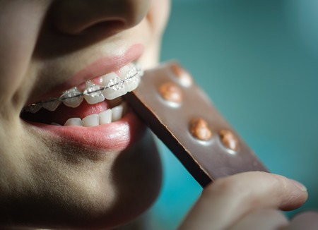 young girl eating chocolate, with ceramic teeth braces