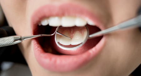 Macro shot of young woman having dental check up in dental clinic. Dentist examining a patient's teeth with dental tools - mirror and probe. Dentistryの写真素材