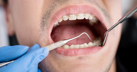 Macro shot of white teeth with braces. Dentist holding probe and mirror and checking up teeth with brackets at the dental office. Orthodontic Treatment.の写真素材