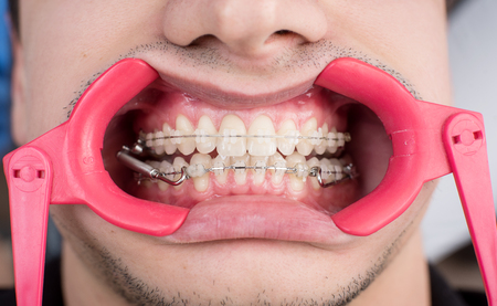 Macro shot of white teeth with braces and dental retractor at the dental office. Orthodontic...