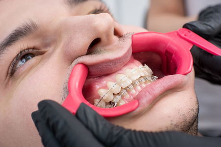 Close-up shot of white teeth with braces and dental retractor at the dental office. Orthodontic Treatment. Dentistryの写真素材