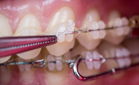 Dentist treating teeth with ceramic brackets, using mosquito at the dental office. Macro shot of teeth with braces. Orthodontic Treatment. Dentistryの写真素材