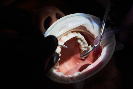 Macro photography of an examination of a patient a clinic with innovative technologies with dark background. The mouth is wide open, the use of a mirror and instruments in the dental clinicの写真素材