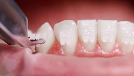 Close up of orthodontist attaching orthodontic brackets on patient teeth. Person with braces on white teeth having dental procedure in clinic. Concept of dentistry and orthodontic treatment.の写真素材