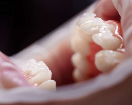 Close up of person with opened mouth and white teeth with orthodontic braces. Patient with cheek...