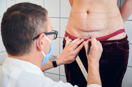 Close up of male doctor drawing marks on woman body before plastic surgery. Plastic surgeon holding ruler and drawing line on abdomen of female patient. Concept of abdominoplasty, cosmetic surgery.の写真素材