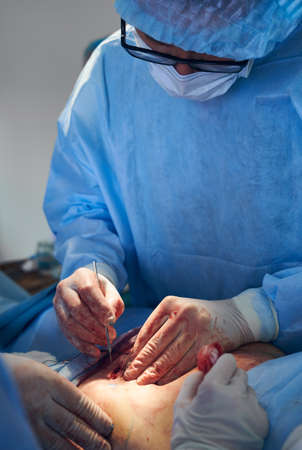 Male plastic surgeon in sterile gloves doing abdominoplasty or tummy tuck surgery in operating room. Doctor wearing surgical uniform, medical face mask while removing excess fat from patient abdomen.の写真素材