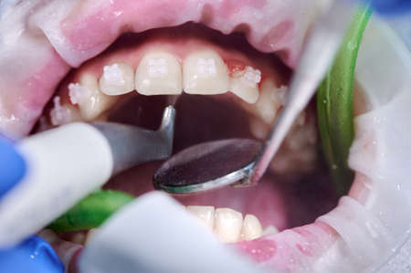 Close up photography. Top view on cleaning process in patients mouth. Cleaning teeth with water jet...
