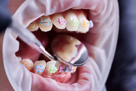 Close up of orthodontist checking patient brackets with dental mirror. Person with cheek retractor in mouth and braces with multicolored rubber bands on teeth having dental procedure in clinic.の写真素材