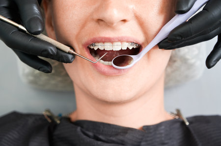 Top view on girls mouth in dentist chair. Cropped dentists hands, in black rubber gloves, checking up braces on patients teeth with steel dental tools. Ceramic and metal brackets. Macro photographyの写真素材