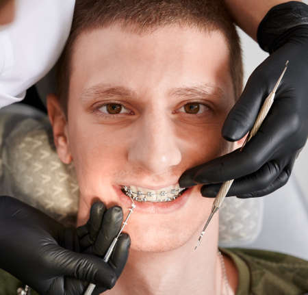 Top view on young mans face in dentists chair during stomatological procedure. Macro photography of dental braces. Doctors hands in gloves holding dental tools, putting on rubber bands on bracketsの写真素材