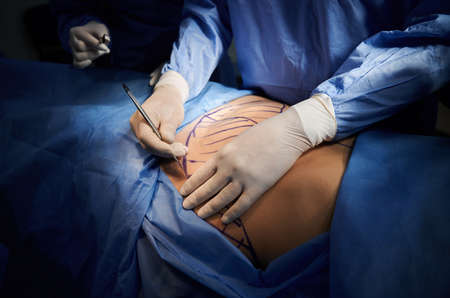 Close up surgeon hands in white sterile gloves using scalpel, doing plastic surgery in operating room. Surgeon cutting patient belly with blue marks on skin. Concept of medicine and abdominoplasty.の写真素材