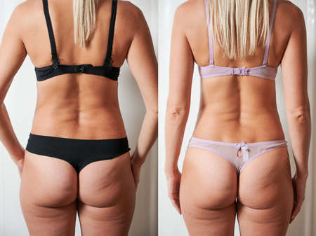 Back view of womans body before and after weight loss, plastic surgery conceptの写真素材