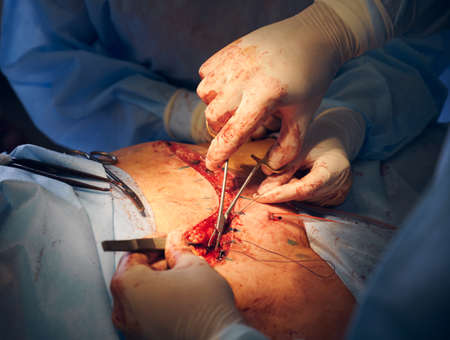 Doctor and assistant placing sutures after abdominoplasty surgery.