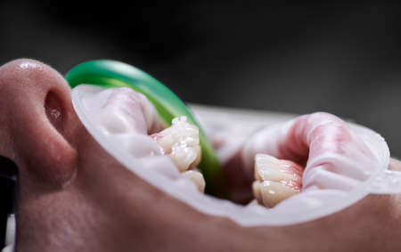 Top view on opened mouth with ceramic braces on white upper teethの写真素材