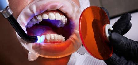 Process of attaching ceramic braces to the teeth with a help of uv glueの写真素材