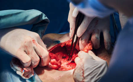 Close up of medical workers hand in sterile gloves doing abdominoplasty surgery. Plastic surgeon and assistant using medical instruments. Concept of medicine, abdominoplasty and plastic surgery.の写真素材