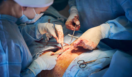 Close up of doctor and assistant in sterile gloves placing sutures after plastical surgical operation. Medical workers performing abdominal plastic surgery in operating room. Concept of abdominoplastyの写真素材