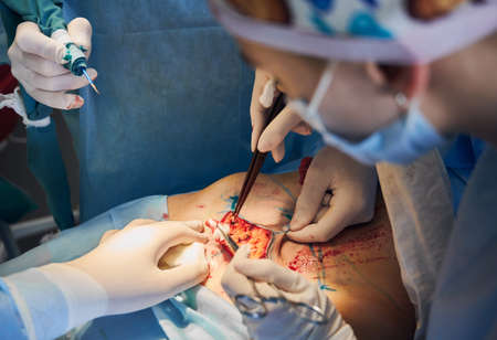 Close up of medical workers in sterile gloves doing plastic surgery in clinic. Plastic surgeon and assistants using medical instruments. Concept of medicine, abdominoplasty and cosmetic surgery.の写真素材