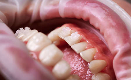 Close up of patient with opened mouth demonstrating white teeth with orthodontic brackets. Young person with cheek retractor in mouth showing dental braces. Concept of dentistry, orthodontic treatmentの写真素材