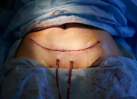 Close up of woman belly with suture line after tummy tuck surgery. Female patient with surgical...