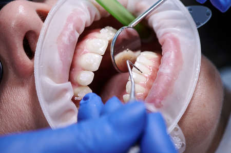 Close up of orthodontist checking woman teeth with dental mirror and explorer. Female patient with...