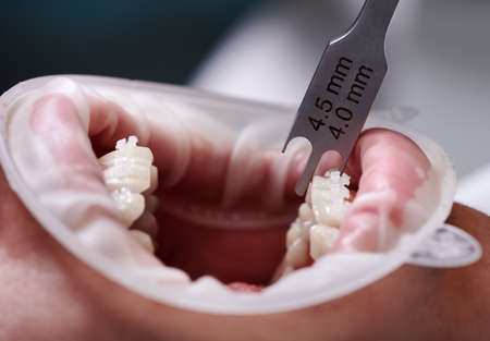 Close up of dentist using aluminum bracket gauge while attaching braces to patient teeth. Person with cheek retractor in mouth and orthodontic brackets on teeth receiving treatment in clinic.の写真素材