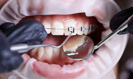 Close up view on dentist in black gloves taking off black rubber bands from ceramic braces with a help of dental hook to replace rusty wire which connects the braces. Concept of orthodontics treatmentの写真素材