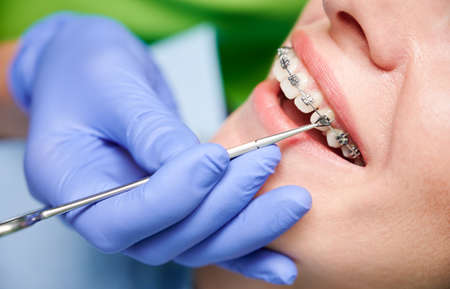 Close up of dentist hand using dental forceps while putting orthodontic braces on female patient teeth. Woman having dental procedure in clinic. Concept of dentistry and orthodontic treatment.の写真素材