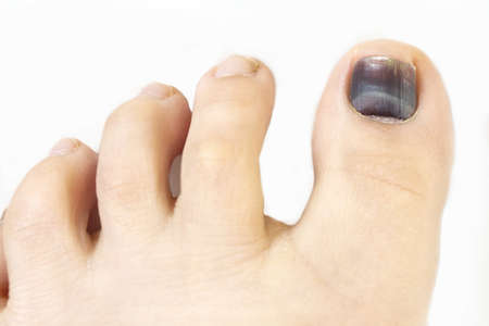 Subungual hematoma blue and black toe nailの写真素材