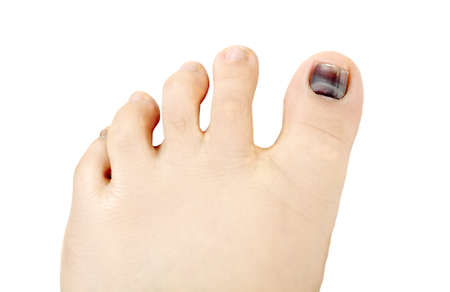 Subungual hematoma blue and black toe nailの写真素材