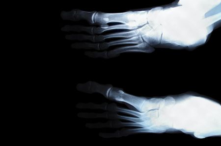 human foot toes close up xray picture の写真素材