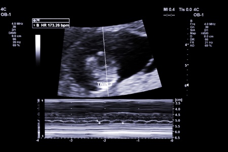 first trimester ultrasound baby xray of Fraternal twin heartbeatの写真素材
