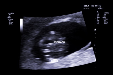 first trimester ultrasound baby xray of Fraternal twin stomach